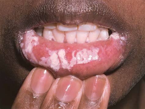 19 Mouth Sore Types and Pictures of What They Look Like