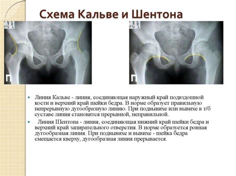 Рентген тазобедренного сустава у детей: расшифровка, норма углов, вред