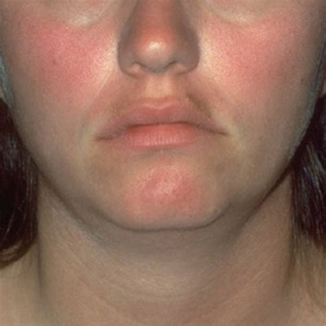 penyakit kulit  mengintai wajah mulusmu bikin nggak cantik