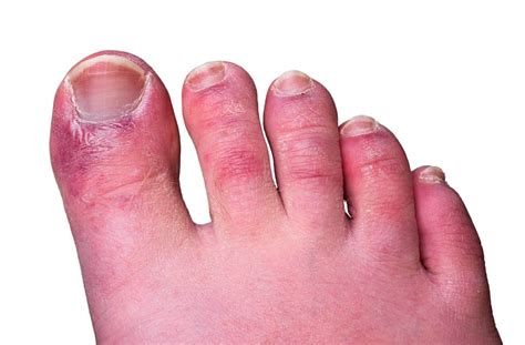 raynauds phenomenon advance foot clinic podiatry