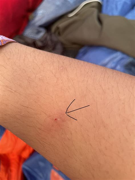 Is this a bat bite? Went camping for Coachella this past weekend. : r/BAT