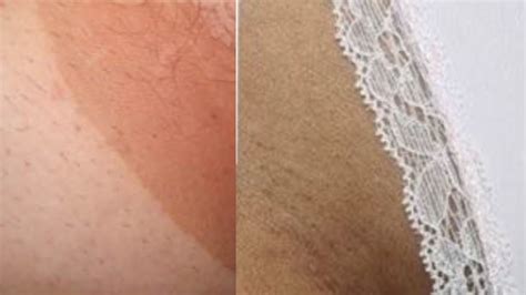 Fotos De Virilhas Escuras Antes E Depois
