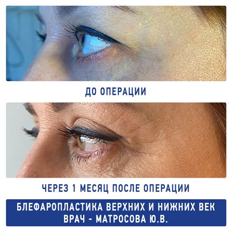Примеры работ по блефаропластике