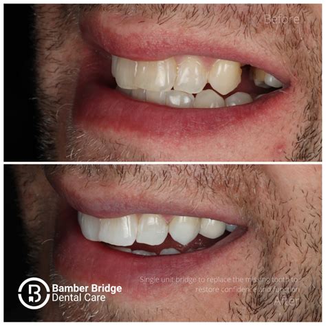 Dental Bridge Before And After