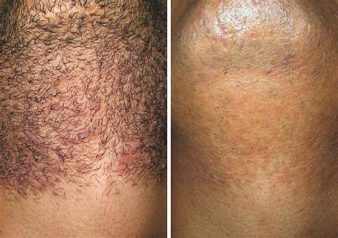 Full Brazilian Laser Hair Removal Before And After Photos