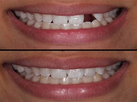 rid   teeth gap quickly stunning dentistry blog
