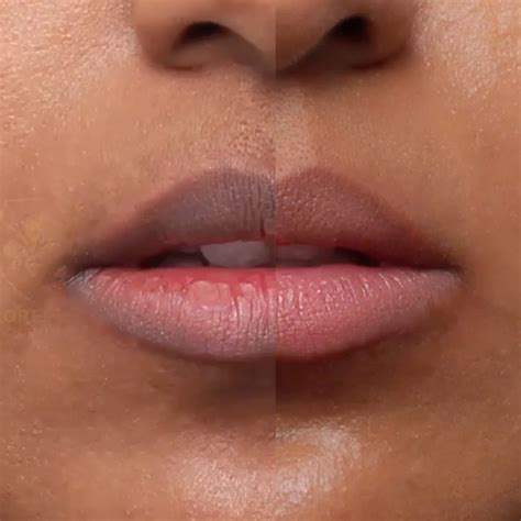pink lips treatment