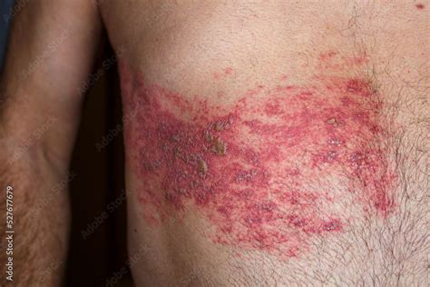 Foto Stock Skin lesion symptom in Shingles or Herpes zoster in human ...