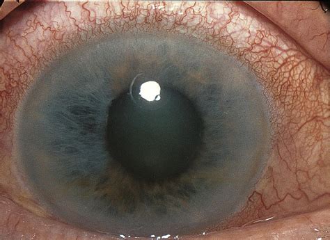 acute angle closure glaucoma american academy  ophthalmology