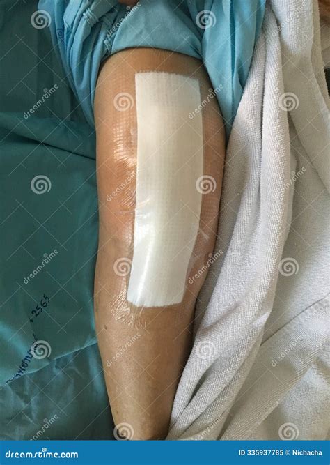 Patient S Knee after Surgery Stock Image - Image of covered, surgery
