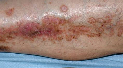 Diabetes And Skin Conditions: Tips For Preventing Them