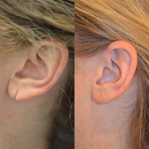 NYC Torn Earlobe Repair | Manhattan Earlobe Plastic Surgery | UES