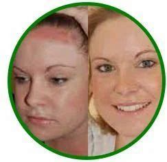 Skin Discoloration Treatment Package in Chennai | ID: 14274209133