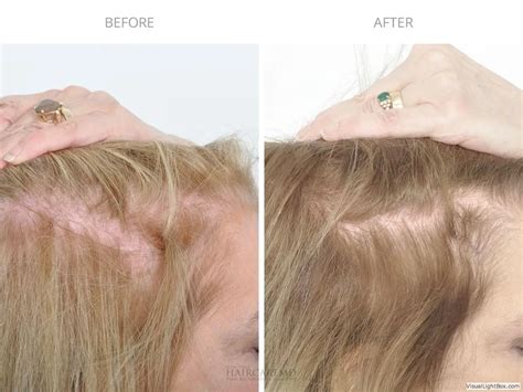 PRP Before and After Photos | HairCareMD - Hair Restoration Surgeons