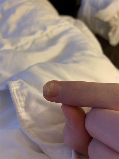 NEED ADVICE - cracked my nail fully across in a 20 game marathon