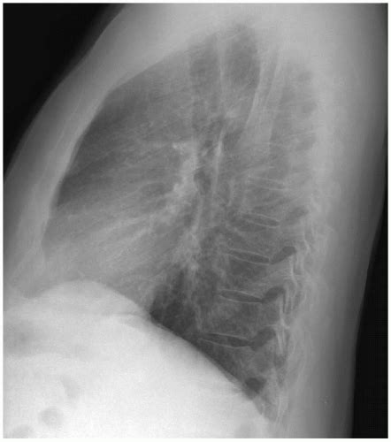 pancoasts tumor thoracic key