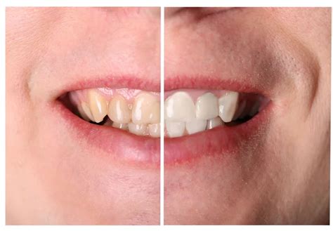 Incisive tooth restoration before and after treatment Stock Photo by ...