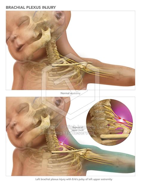 Brachial Plexus Injury | High Impact, LLC