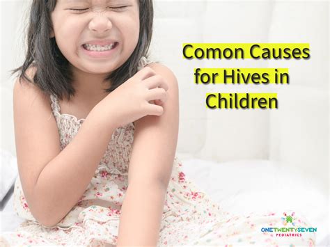 What Causes Hives in Kids Out of Nowhere? - 127 Pediatrics