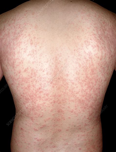 pityriasis rosea histology pityriasis rosea dkrisp
