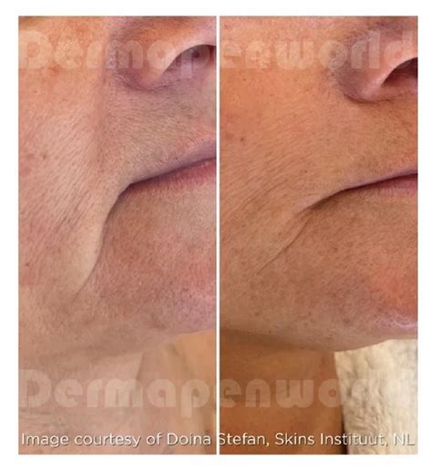 Exosomes Treatment in Skincare: Transform Your Skin at Jack Nathan ...