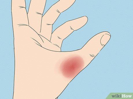 how to know if my thumb is broken