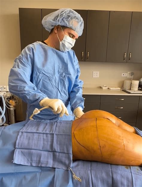 Nonsurgical vs. Surgical BBL in Chicago: Safe Brazilian Butt Lift