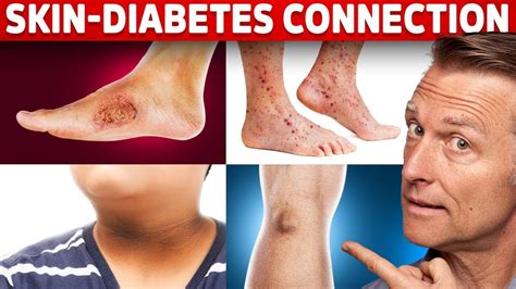9 Diabetic Skin Problems That Indicate Diabetes - YouTube