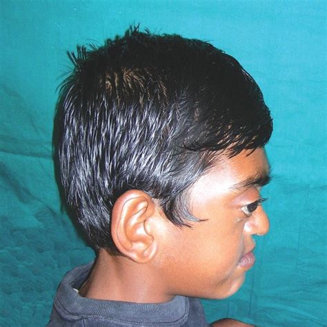 Extraoral photograph showing midface hypoplasia with a relative ...