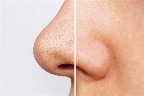 Como Tirar Pontos Pretos Do Nariz - Close do nariz da mulher com cravos ou pontos pretos antes e depois da ...