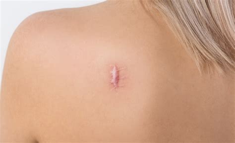scar revision surgery  intracel derma revive skin clinic