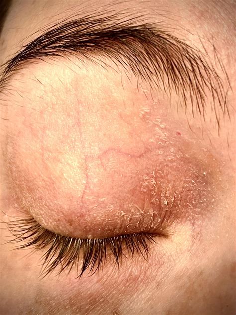 Causes and Treatments for Red Dots on Your Eyelids 26