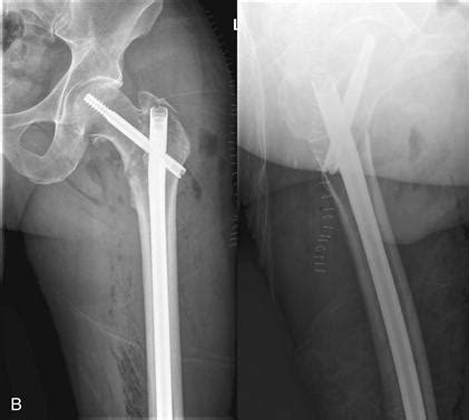 Intertrochanteric Fracture Xray