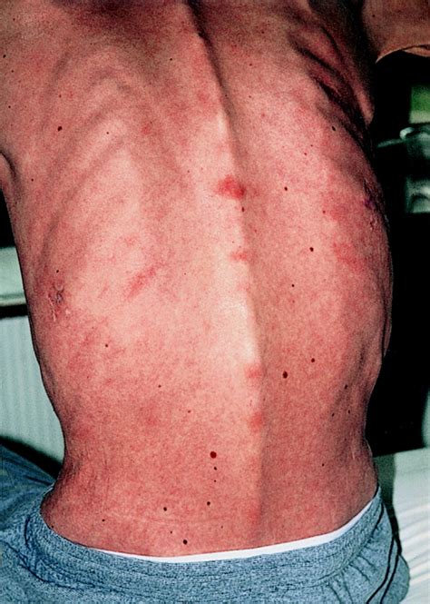 Aids Pictures Of Sores