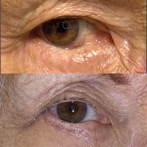 Blepharoplasty Panama City | Eyelid Surgery Panama City Beach