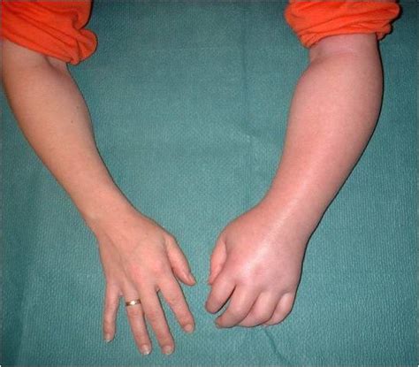 shoulder hand syndrome pkpt clinic