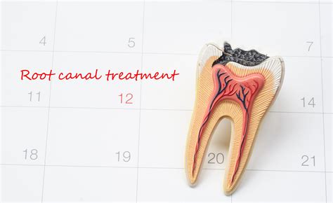 root canal procedure  performs      cost