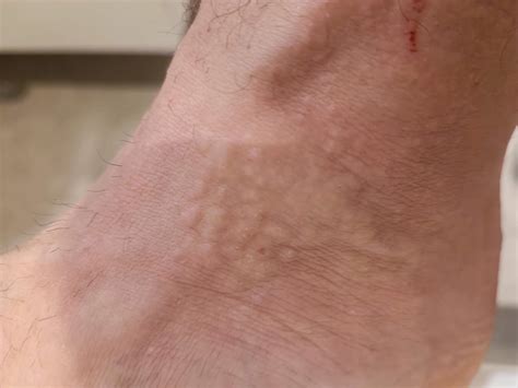 Allergie vom Skifahren? (Ausschlag)