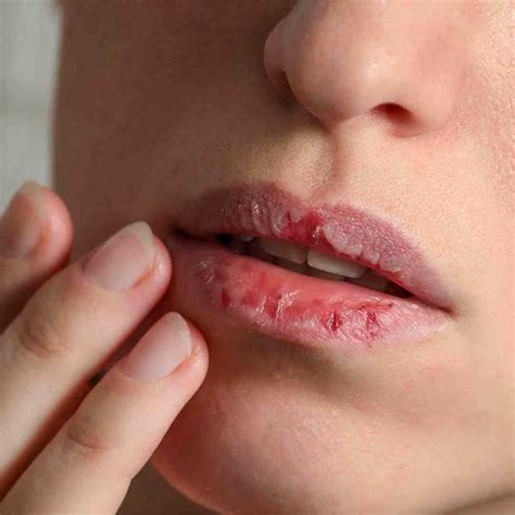 rid  chapped lips home remedies