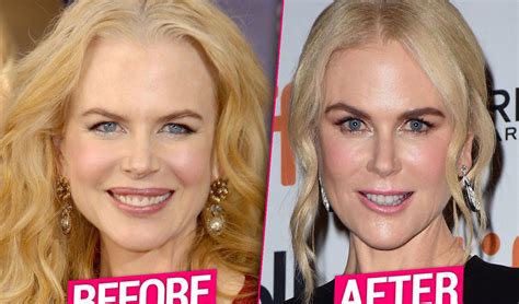 Nicole Kidman’s Plastic Surgery Transformation -- Top Docs Claim ...