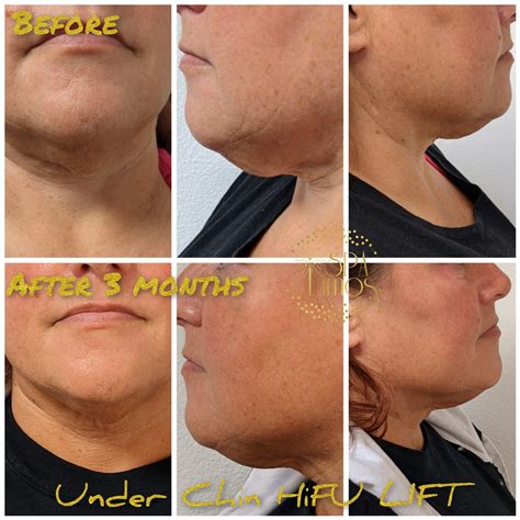 high intensity focused ultrasound for face 8