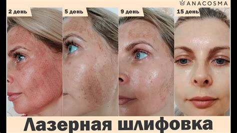 ️Лазерная шлифовка лица: до и после ️ ️ ️ Реальный результат ️ ️ ️ ...