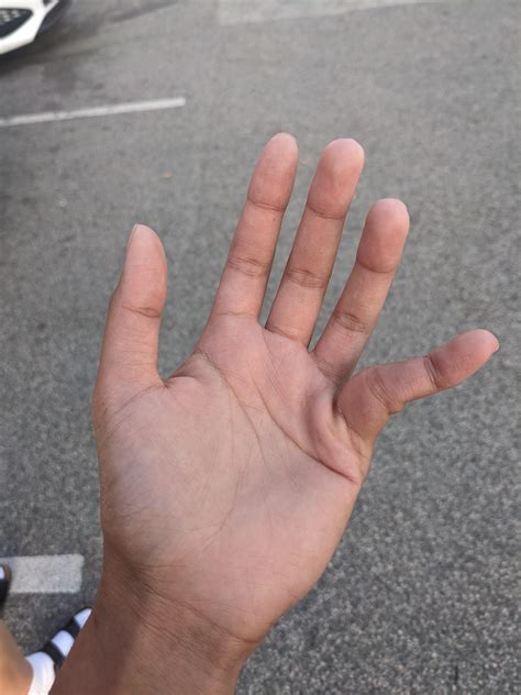 Dislocated Pinky Finger