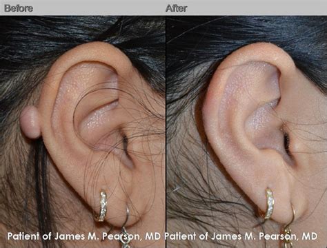 Keloid Removal - Dr. James Pearson Facial Plastic Surgery