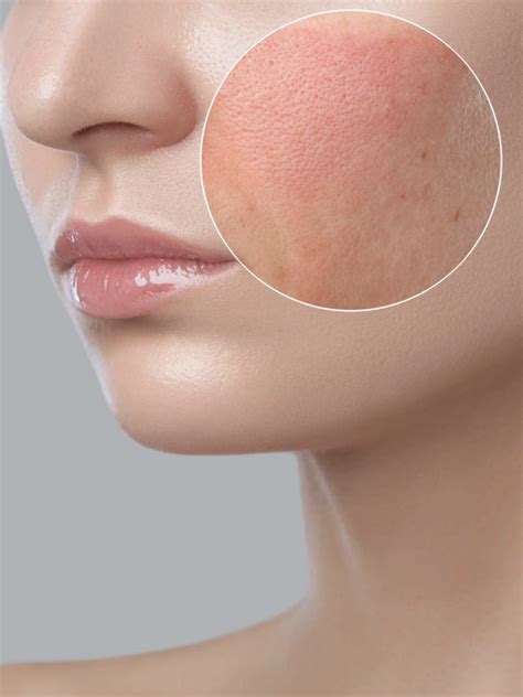 Sensitive Skin Treatment | Rosacea Treatment | Acclaro Medical Aesthetics Clinic in Singapore ...