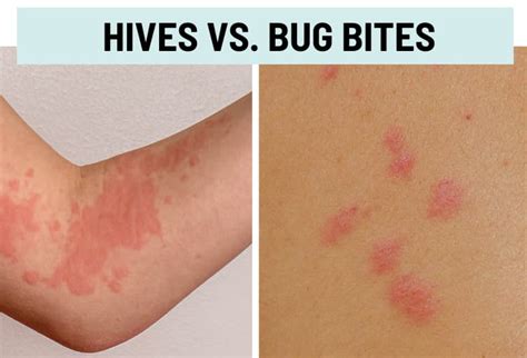 Hives (Urticaria) vs. Rash: Pictures and Differences