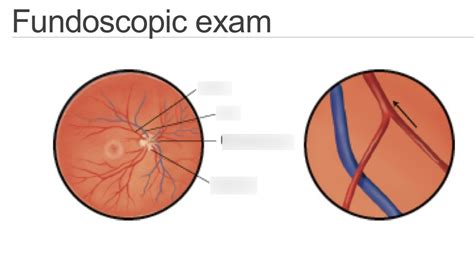 fundoscopic exam Diagram | Quizlet