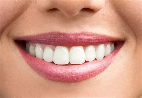 Why Overlapping Teeth Happen and How to Treat Them