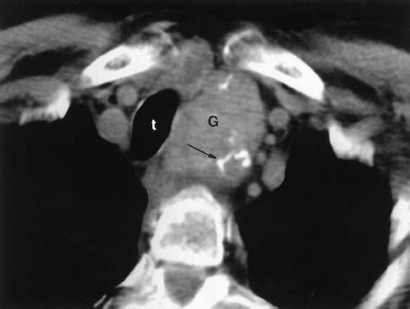 Primary mediastinal tumors. Part 1: Tumors of the anterior mediastinum (PDF Download Available)