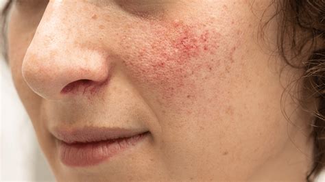 erythematotelangiectatic rosacea  remedies gladskin